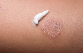 Thuốc trị bôi lác đồng tiền