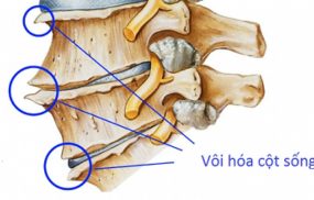 Vôi hóa đốt sống đang có dấu hiệu ngày càng trẻ hóa.