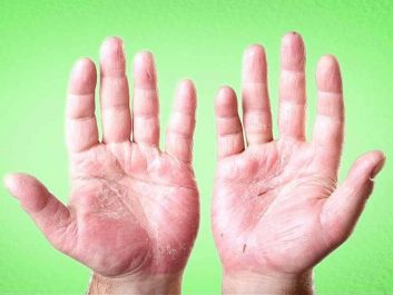 Những điều cần biết về bệnh á sừng