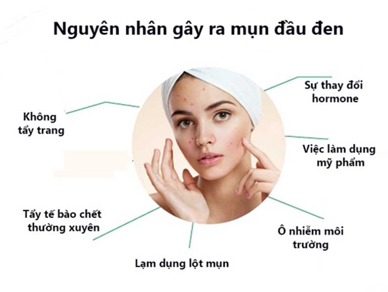Mụn đầu đen