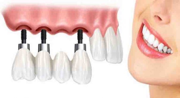 Địa chỉ trồng cấy ghép răng Implant uy tín chất lượng tại Đà Nẵng