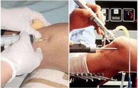 Vị trí và quy trình chọc hút dịch khớp gối