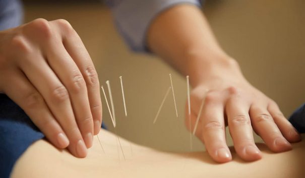 Châm cứu, bấm huyệt là những phương pháp Đông y điều trị nhiều bệnh lý