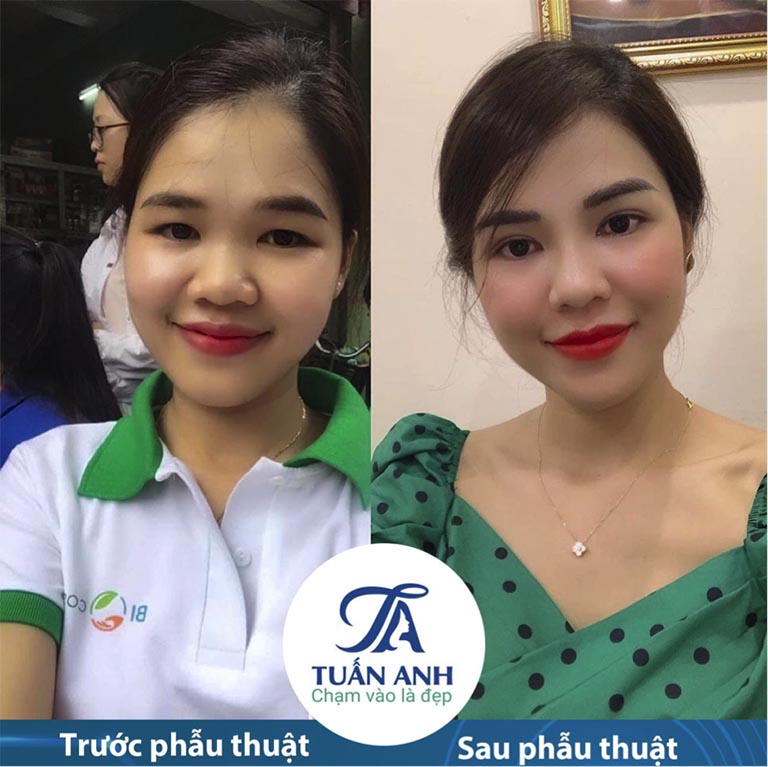 Bác sĩ trần tuấn anh cắt mí đẹp 