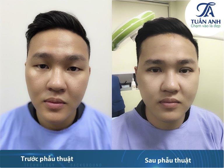 Cắt mí nam bác sĩ trần tuấn anh 