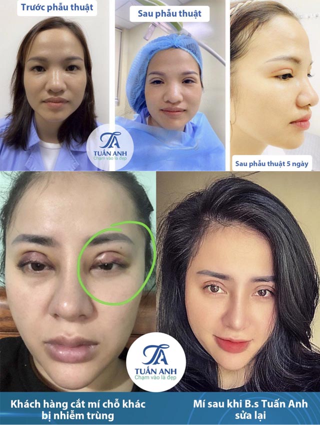 Phẫu thuật cắt mí bác sĩ trần tuấn anh
