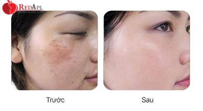 thay da sinh học tại red pearl