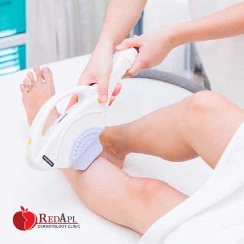 Triệt lông tại phòng khám da liễu táo đỏ 