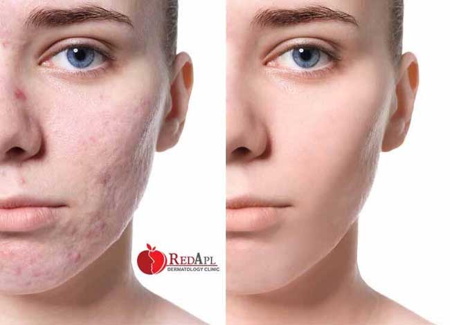 Xoá sẹo tại phòng khám da liễu táo đỏ 