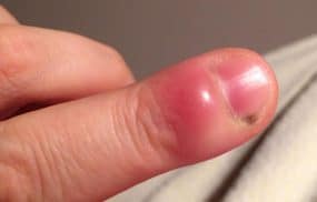 Ngón tay bị sưng đỏ, đau nhức là dấu hiệu bệnh gì?