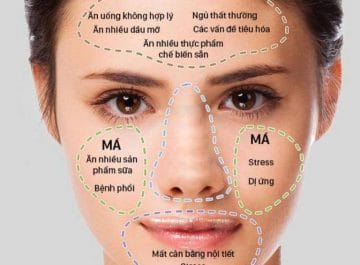 Mụn cám ở má do nhiều nguyên nhân gây ra, có thể do thay đổi hormone, thói quen chăm sóc da, yếu tố tâm lý hoặc liên quan đến vấn đề về phổi