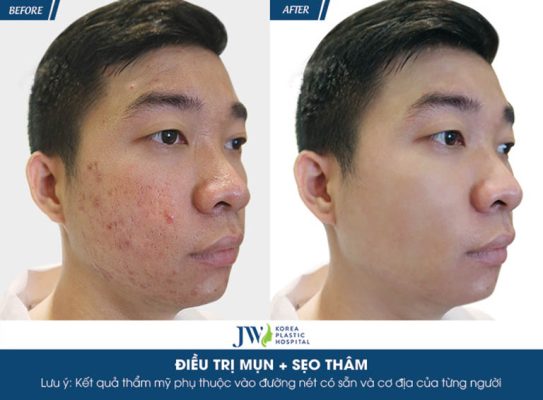 spa trị mụn cho nam tại TPHCM uy tín