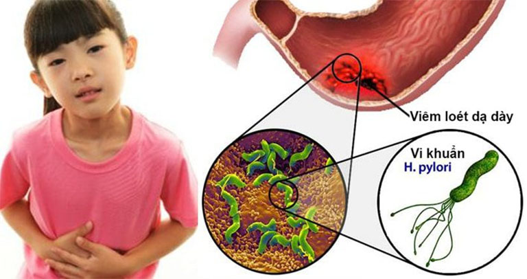 Cây thuốc nam trị viêm loát dạ dày - Khám Phá Lợi Ích Từ Thiên Nhiên Cây thuốc nam trị viêm loát dạ dày - Khám Phá Lợi Ích Từ Thiên Nhiên